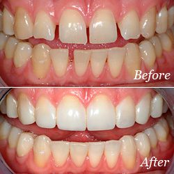 Before and After Teeth Bonding