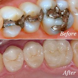 Dental Fillings - Critchfield Dental