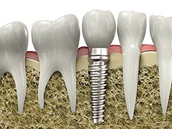 Dental Implant Model