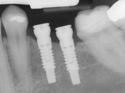 Dental Implants X-ray