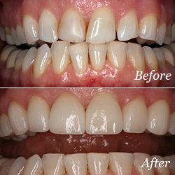 Before and After Dental Veneers